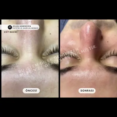Cilt Bakımı Öncesi Sonrası Mersin